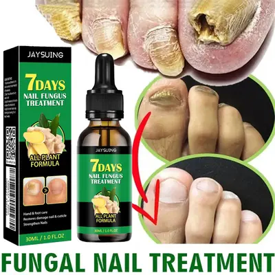 Nail Fungus Treatment β Triple-Action Formula Daily Repair for Brittle, Thick & Discolored Nails β Ginger & Undecylenic A...