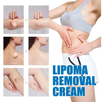 Relieve subcutaneous lumps caused by lipoma-fat cream