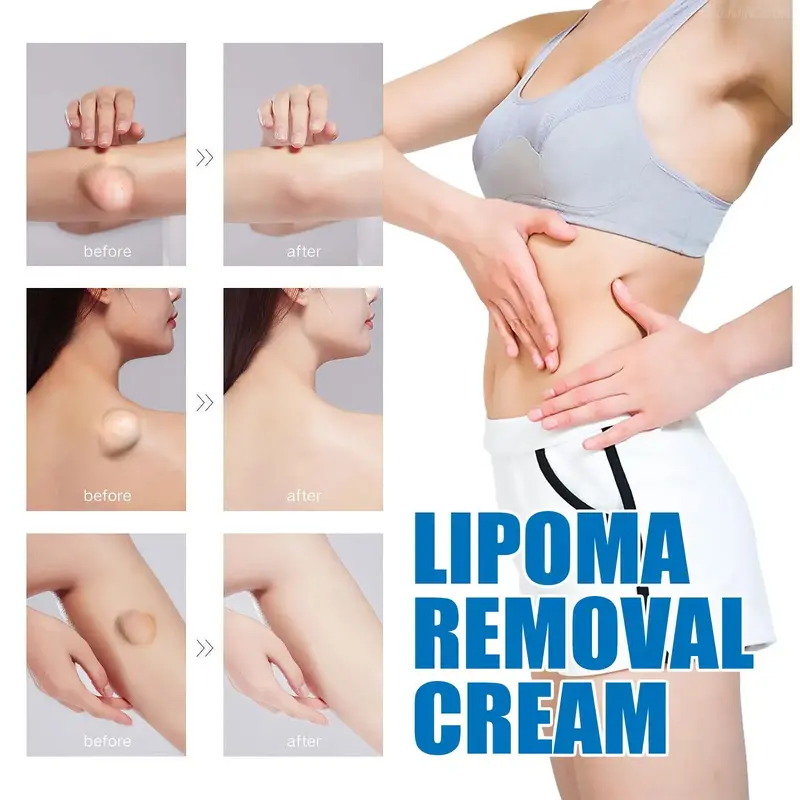 Relieve subcutaneous lumps caused by lipoma-fat cream
