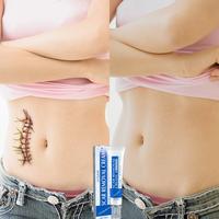 Professional Scar removal gel- Scarremoval treatment for keloids, C-sectionS, surgeries, burns, acne andmore.