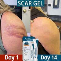 West&Month High-Grade Formula Scar Gel, Scar Repair Surgery Scar Pregnancy Smoothing Skin Care Gel